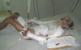 Bỏng nặng vì vừa rút xăng vừa hút thuốc