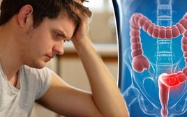 Ngày càng nhiều người trẻ mắc ung thư đại trực tràng, bác sĩ chỉ đích danh 1 triệu chứng rất hay bị bỏ sót