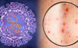 Xuất hiện ca bệnh đậu mùa khỉ chưa rõ nguồn lây ở Đồng Nai