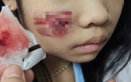 Khỉ hoang tấn công, bé gái 7 tuổi nhập viện