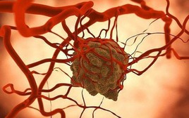 Vượt qua ung thư gan, đây là căn bệnh ung thư có tỷ lệ mắc cao số 1 ở người Việt: Có tính di truyền