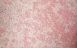 Người đàn ông nhiễm nấm vùng kín vì thói quen nhiều người làm với đồ lót của mình