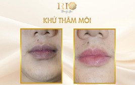 Hết thâm môi nhanh nhờ công nghệ khử thâm môi mới
