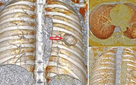 Xét nghiệm có chỉ số mang thai, cô gái ngỡ ngàng khi “thủ phạm” là ung thư tạo triệu chứng đánh lừa