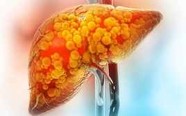 Gầy như “xác ve” vẫn bị gan nhiễm mỡ: Bác sĩ chỉ rõ 6 nguyên nhân, số 6 rất phổ biến