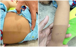 Bé 2 tuổi bị "chấn thương vùng kín", nghi xảy ra ở điểm giữ trẻ: Chủ cơ sở có câu trả lời không thỏa đáng