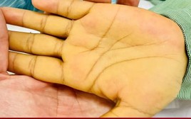 5 dấu hiệu nhận biết sớm ung thư gan không nên bỏ qua