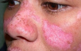 Cô gái Huế đột ngột qua đời trước ngày cưới nửa tháng do mắc bệnh lupus ban đỏ: Cảnh báo 1 nhóm phụ nữ nguy cơ cao mắc bệnh