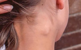 3 bất thường ở cổ cảnh báo ung thư, hãy đi khám bác sĩ ngay lập tức