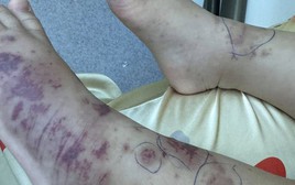 Chuyên gia cảnh báo về một căn bệnh nguy hiểm, lây lan nhanh, tỉ lệ tử vong cao