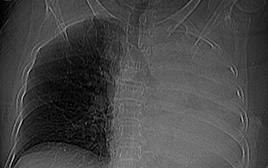 Sặc một viên thuốc, cụ bà xẹp toàn bộ phổi trái