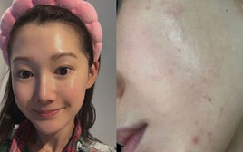 Beauty editor 29 tuổi, da tốt mà vẫn toang vì mụn: Hành trình “cứu” da chỉ với 6 sản phẩm nền tảng