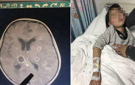 Bé gái lớp 2 não "bị ăn mòn chục lỗ", chậm chút là rỗng hoàn toàn: Thủ phạm rất phổ biến trong mọi gia đình