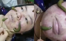 Ớn lạnh dùng đỉa hút mụn, bác sĩ cảnh báo hiểm họa