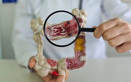 Ung thư đại tràng thường "để ý" những người có 2 đặc điểm này: Nếu có cần hành động ngay!