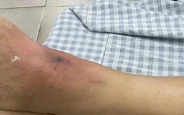Liên tiếp các trường hợp rết cắn phải nhập viện