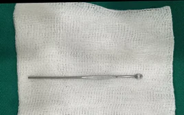Bé trai 14 tuổi nhập viện vì dị vật dài 12cm trong niệu đạo