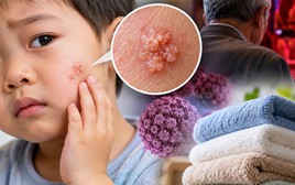 Bé trai 3 tuổi bị sùi mào gà trên mặt, bác sỹ nói do dùng chung khăn tắm