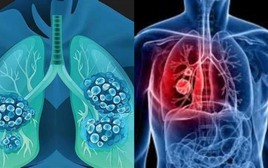 WHO khuyến cáo chỉ cần thay đổi một điều này, nguy cơ UNG THƯ có thể giảm mạnh: Gần 40% ca bệnh hoàn toàn có thể phòng tránh