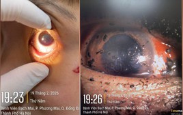 Bệnh viện Bạch Mai cảnh báo 1 tình trạng bệnh ở mắt tăng vọt ngay trong 3 ngày đầu năm 2026