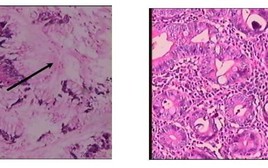 Bệnh viện 115 cảnh báo loại giun ký sinh trong ruột: Không triệu chứng, nhưng gây tử vong nếu uống sai thuốc kháng sinh