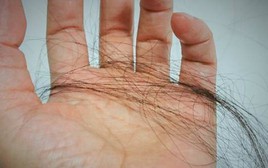 Một phụ nữ giảm được 10kg nhưng lại bị hói đầu: Bác sĩ tiết lộ 4 nguyên nhân chính không ai ngờ