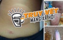 Thực hư thông tin bé 3 tuổi bị sâu biển cắn nguy kịch, gia đình tha thiết kêu gọi hỗ trợ máu hiếm