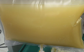 Nam sinh năm nhất "máu trắng như sữa", mỡ máu cao gấp 47 lần bình thường vì thói quen ăn uống nhiều người mắc