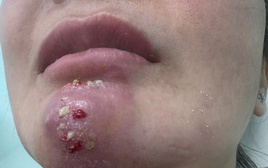 Tin quảng cáo “bật tông nhanh”, nhiều người biến dạng mặt vì làm đẹp cận Tết