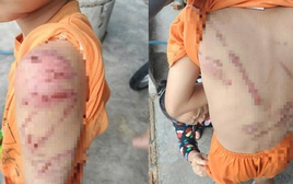 Xót xa hình ảnh cháu trai nghi bị cha đánh bầm tím khắp người