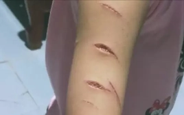 Vụ nữ sinh lớp 5 ở Cà Mau bị rạch tay: Sở Y tế đề xuất biện pháp xử lý