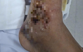 Đắp thuốc, một người đàn ông suýt mất chân