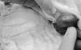 Nửa đêm đau âm ỉ vùng kín, nam sinh suýt mất tinh hoàn vì chủ quan