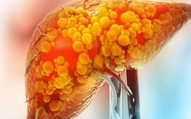 Bác sĩ nói thẳng: Thói quen này âm thầm gây gan nhiễm mỡ nhưng toàn bị xem nhẹ