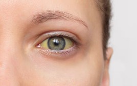 Cảnh báo 4 dấu hiệu của loại ung thư "sát thủ thầm lặng": Nếu có phải đi khám ngay