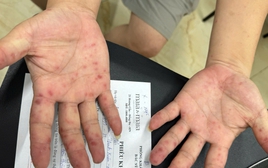 Số ca tay chân miệng tăng mạnh, cảnh báo nguồn lây từ tay nắm cửa, đồ chơi