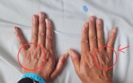 Tê ngón tay út tưởng chuyện nhỏ, người đàn ông suýt teo cả bàn tay