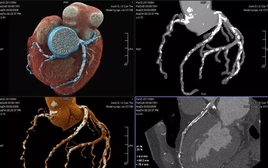 Bệnh nhân thoát nguy cơ ‘thượng mã phong’ nhờ chia sẻ chuyện phòng the