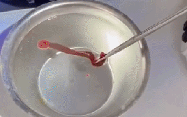 Rùng mình với dị vật "cố thủ" nhiều ngày trong mũi người đàn ông 38 tuổi