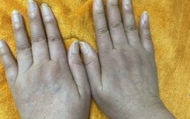 Nữ doanh nhân có 1 dấu hiệu lạ ở tay nhiều năm: Đi khám bác sĩ cảnh báo hàng loạt tạng đang "gặp nguy"