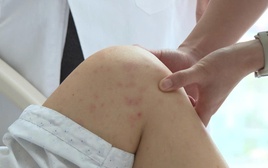 Hà Nội: Cô giáo mầm non viêm phổi do mắc thủy đậu, sai lầm vì "tôi nghĩ thủy đậu là bệnh của trẻ em"