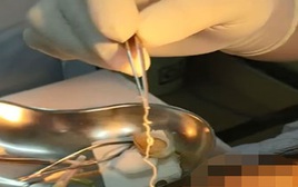 "Sốc nặng" với chàng trai 24 tuổi nhưng 13 năm bị sinh vật sống "gặm nhấm" não, gây tàn tật: Gắp ra ngoài còn ngoe nguẩy