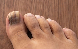 Dấu hiệu ở móng chân cảnh báo loại ung thư nguy hiểm: Nhiều người bỏ qua, bác sĩ khẩn thiết nhắc nhở