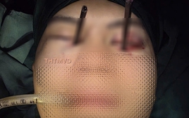 Hy hữu: Nam thanh niên 25 tuổi bị 2 chiếc đũa đâm thẳng vào 2 mắt cùng lúc