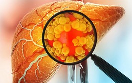 Đảo ngược gan nhiễm mỡ không cần ăn kiêng: Đột phá từ Mỹ