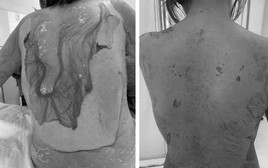 Hải Phòng: 1 phụ nữ 35 tuổi bị tróc da như "cua lột" vì thói quen dùng thuốc cực kỳ phổ biến