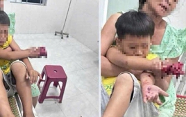 Cháu bé bị dập bàn tay nghi do điện thoại nổ lúc sạc pin