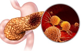 3 người trong 1 nhà đều mắc ung thư tuyến tụy: Bất ngờ với "thủ phạm"