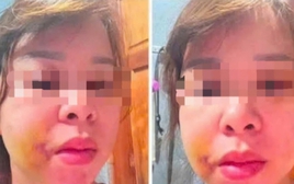 Người mẹ 3 con ở Đắk Lắk cầu cứu sau nhiều lần bị chồng hành hung
