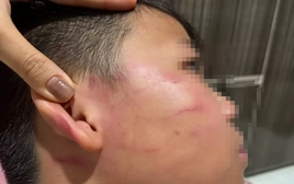 Vụ giáo viên nước ngoài tát học sinh: Gia đình nói bé trai bị thủng màng nhĩ